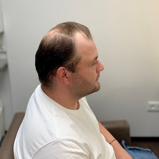 Haarverlust Männer Seitenprofil